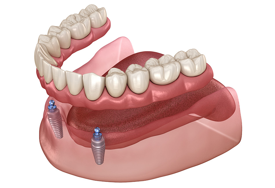 Full Arch Dental Implants